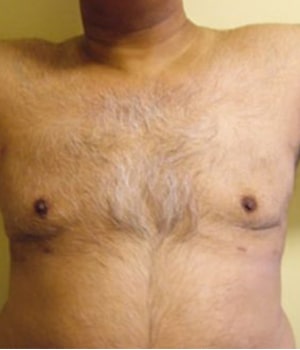 Liposuction & Breast Reduction 3