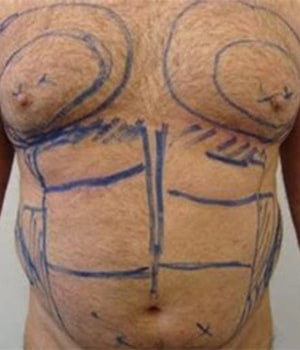 chest contouring1