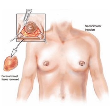 liposuction and breast gland removal 1