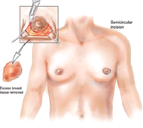 breast gland removal 2