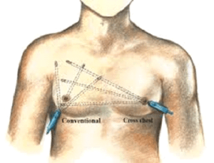 chest liposuction 2